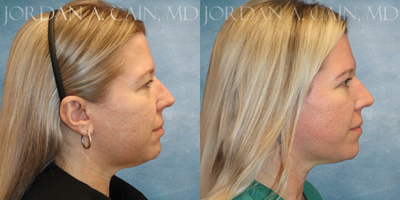 Brow Lift before and after photo