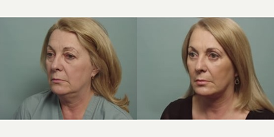 Facelift before and after photo