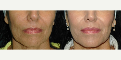Juvederm before and after photo