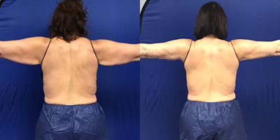 Laser Liposuction before and after photo