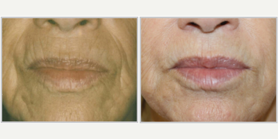 ProFractional Laser before and after photo