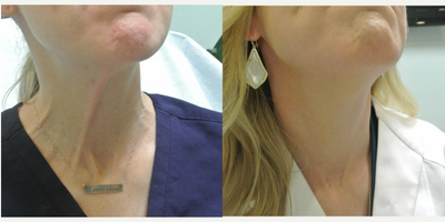 Botox before and after photo