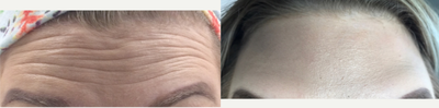 Botox before and after photo