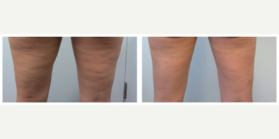 Cellulaze before and after photo