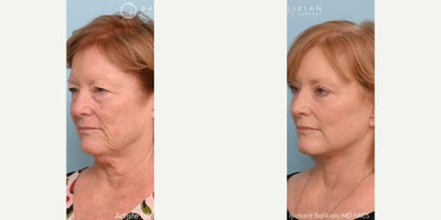 CO2 Laser before and after photo