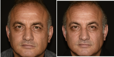 Eyelid Surgery before and after photo