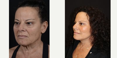 Facial Fat Transfer before and after photo