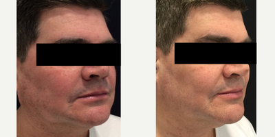 Laser Resurfacing before and after photo
