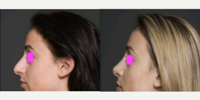 Rhinoplasty before and after photo