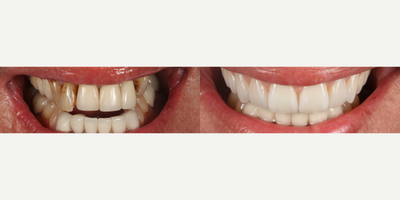 Dental Implants before and after photo