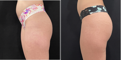 Emsculpt before and after photo