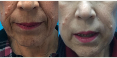 Lip Fillers before and after photo