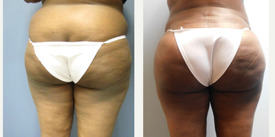 Brazilian Butt Lift before and after photo
