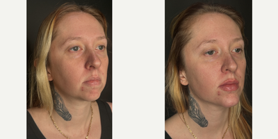 Chin Filler before and after photo
