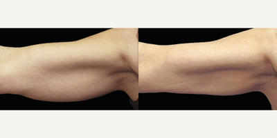 CoolSculpting before and after photo