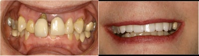 Dental Implants before and after photo
