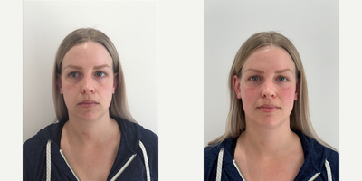 Dermal Fillers before and after photo