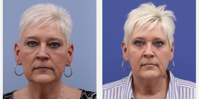 Eyelid Surgery before and after photo