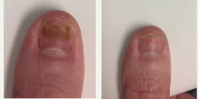Laser Genesis before and after photo