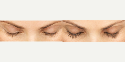 Latisse before and after photo