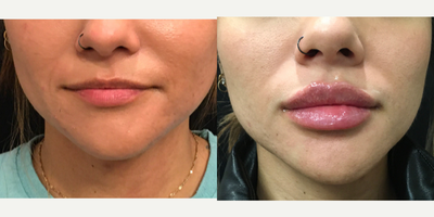 Lip Fillers before and after photo
