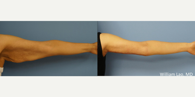 Arm Lift before and after photo