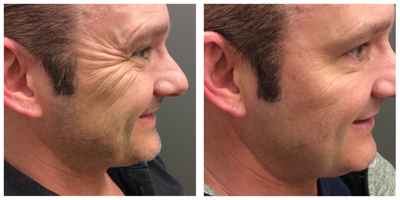 Botox before and after photo