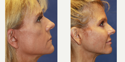 Cheek Augmentation before and after photo