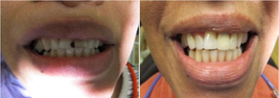 Dental Bonding before and after photo