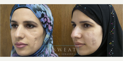 Dermal Fillers before and after photo