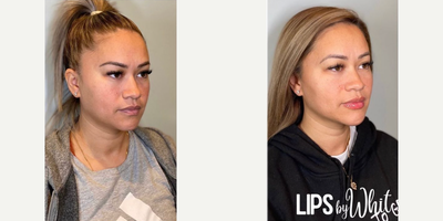 Chin Filler before and after photo