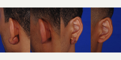 Earlobe Repair before and after photo