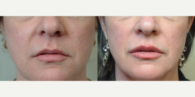 Juvederm before and after photo