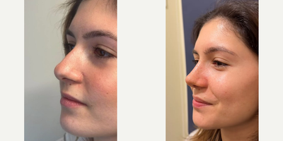 Septoplasty before and after photo
