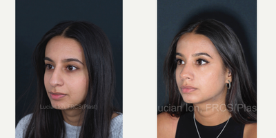 Asian Rhinoplasty before and after photo