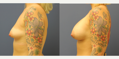 Breast Augmentation before and after photo