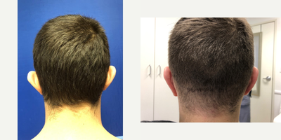 Ear Surgery before and after photo