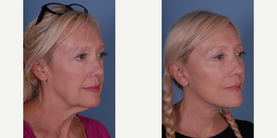 Eyelid Surgery before and after photo