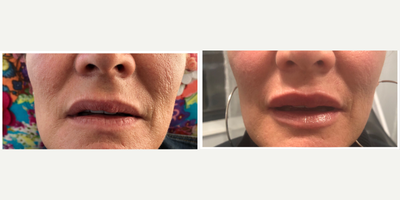 Lip Fillers before and after photo