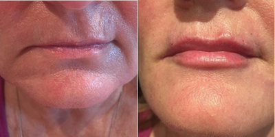 Liquid Facelift before and after photo