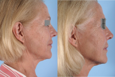 Nonsurgical Facelift before and after photo