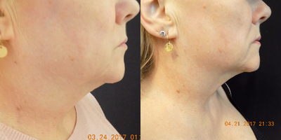 CoolMini before and after photo