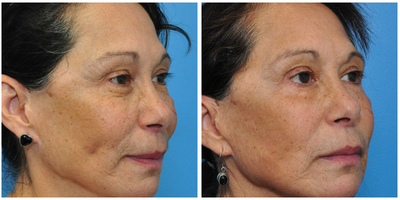 Eyelid Surgery before and after photo