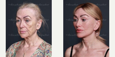 Eyelid Surgery before and after photo