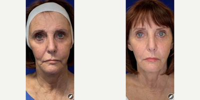 PRP Injections before and after photo