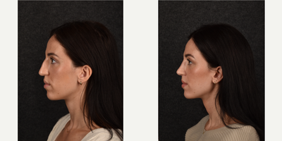 Rhinoplasty before and after photo