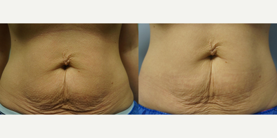 Exilis before and after photo