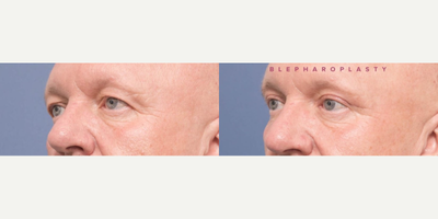 Eyelid Surgery before and after photo