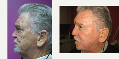 Laser Resurfacing before and after photo