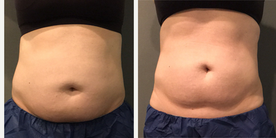 CoolSculpting before and after photo